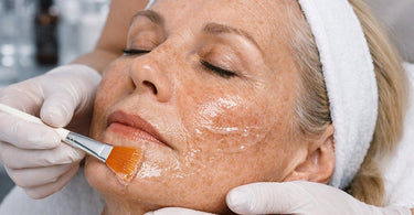 Close-up of a woman's face receiving a professional chemical peel treatment for hyperpigmentation, showing glowing, even-toned mature skin.