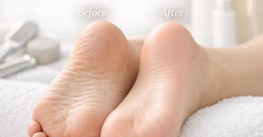 Professional pedicure tools and creams for safe and effective callus reduction displayed on a spa table.