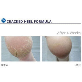 Footlogix Cracked Heel Formula 3and 4.2 oz