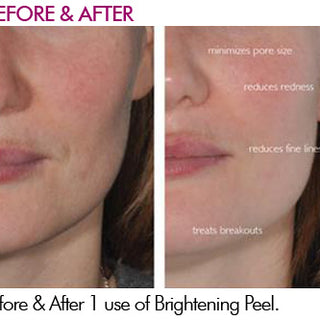 Brilliant Skin Brightening