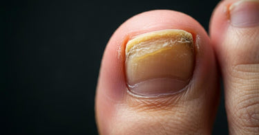 Top Nail Fungus Products for Professional Use at Pure Spa Direct