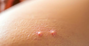 Do Ingrown Hair Products Prevent Ingrown Hairs?