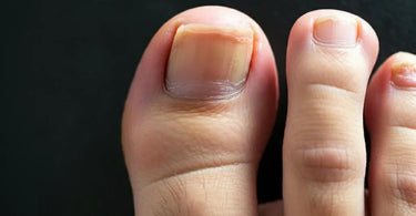 Never Ignore Discolored Toenails - Footlogix to the Rescue