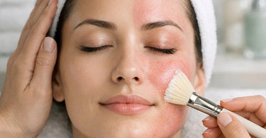 Side by side comparison of skin purging versus an allergic reaction, showing close-up details of blemishes and irritated skin.