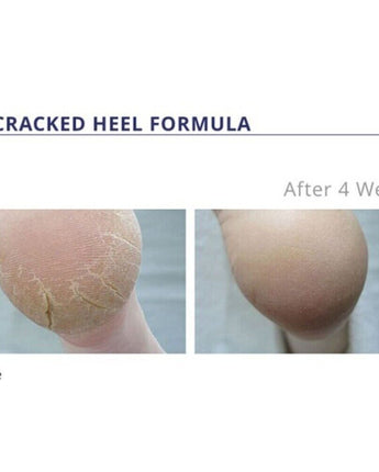 3+ Cracked Heel Formula #3+ / 4.2 oz. by Footlogix