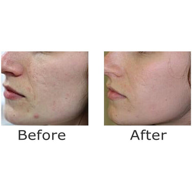 6 Function Skin Rejuvenator - Red LED + Blue Light LED + Oxygen Mask + Oxygen Jet Peeling Pen + Diamond Microdermabrasion + Multipolar RF by Meishida