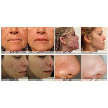 Aqua Peel Microdermabrasion - Non-Laser Skin Resurfacing by Meishida