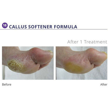 Callus Softener Formula #18 / 1 Gallon by Footlogix