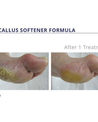 Callus Softener Formula #18 / 1 Gallon by Footlogix