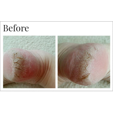 Dr. Canuso Foot Repair Serum - Dry, Cracked Heel Treatment / 1 Case = 8 Units X 1 oz. - 30 mL. Each by Dr. Canuso