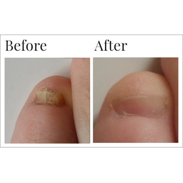 Dr. Canuso Fungal Nail Eraser Liquid - Topical Anti-Fungal Treatment / 1 Case = 8 Units X 0.5 oz. - 15 mL. Each by Dr. Canuso