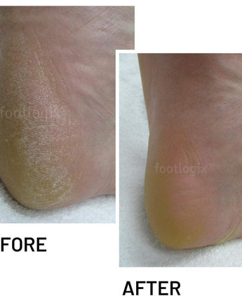 FootLogix Cracked Heel Formula / 4.2 oz.