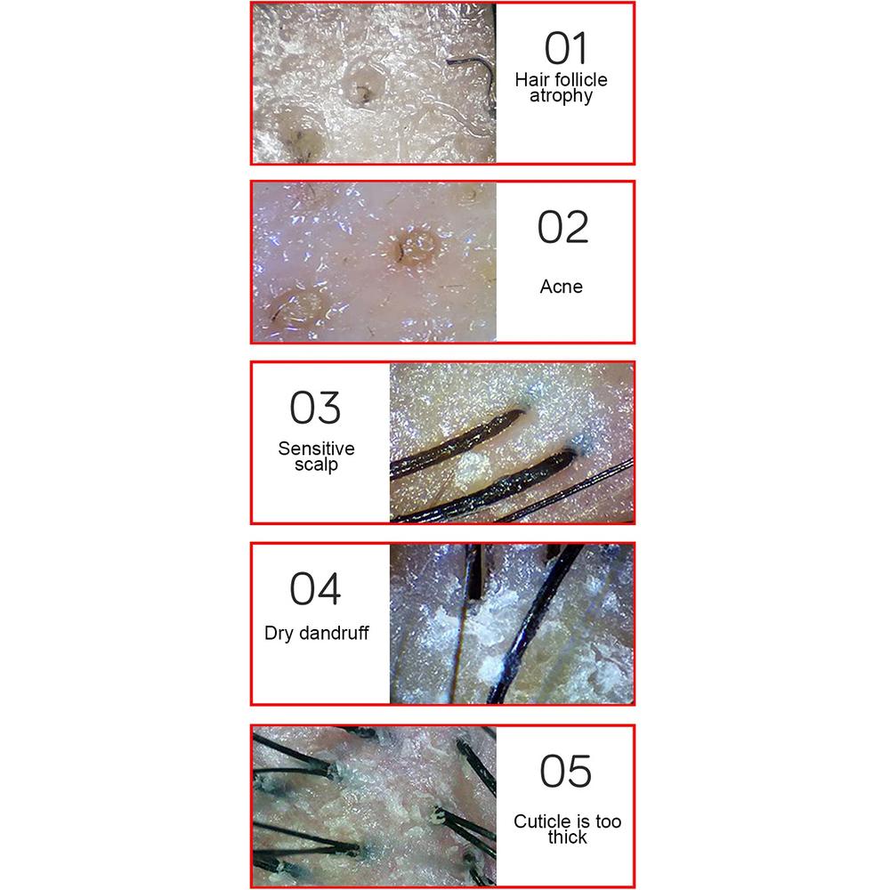 Scalp Hair Analyzer Digital Microscope Device - Ideal Add On For Japan ...